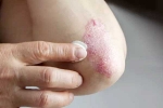 Skin disorders latest, Skin disorders related, five common skin disorders and their symptoms, Acne