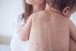 measles in united states, measles in united states, measles back in the united states as children omit vaccination doses, Toddler
