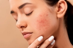 skin care products, dermatologist, 10 ways to get rid of pimples at home, Acne