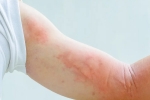 symptoms, coronavirus, dermatological symptoms could be a sign for covid 19 infection, Sexually transmitted disease