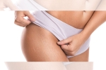 white stretch marks before and after, health and fitness, difference between red and white stretch marks explained and it s natural to have them, Stretch marks